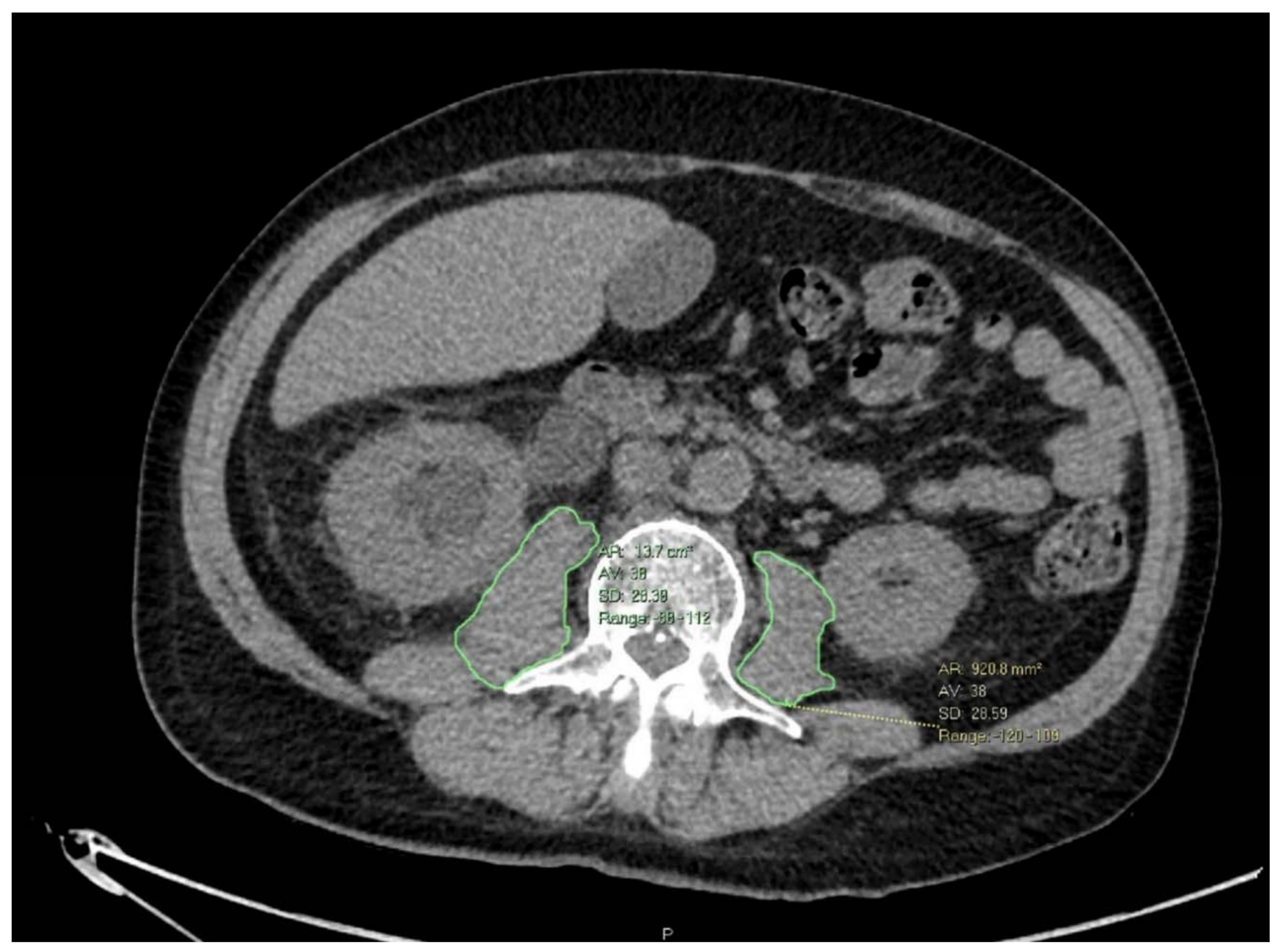 Nutrients | Free Full-Text | Nutritional Status Impairment Due to ...